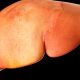Non Alcoholic Fatty Liver Disease